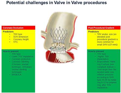 Transcatether Aortic Valve Implantation to Treat Degenerated Surgical Bioprosthesis: Focus on the Specific Procedural Challenges